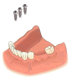 implantls